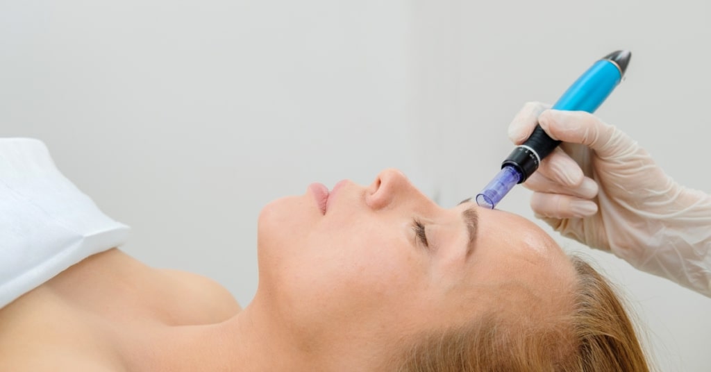 Microneedling